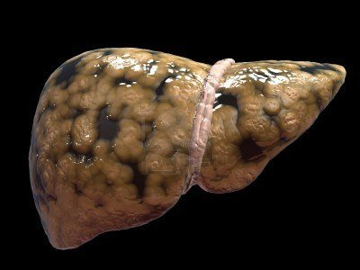 Fatty Liver