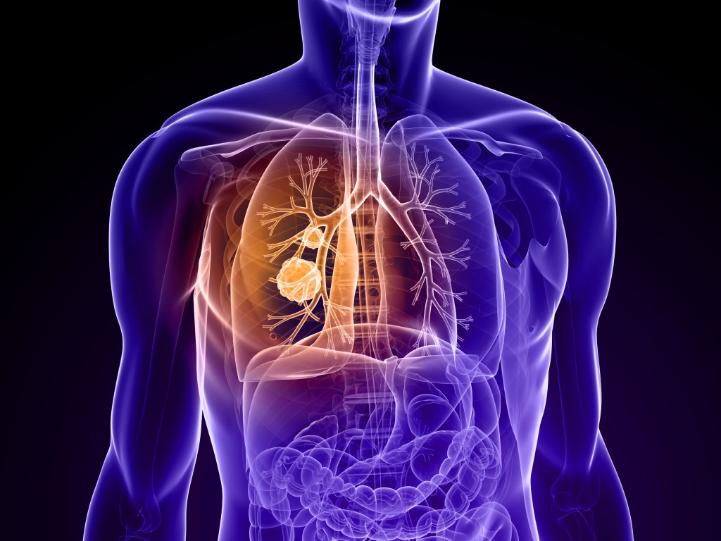 Are You At Risk of&nbsp;COPD?
