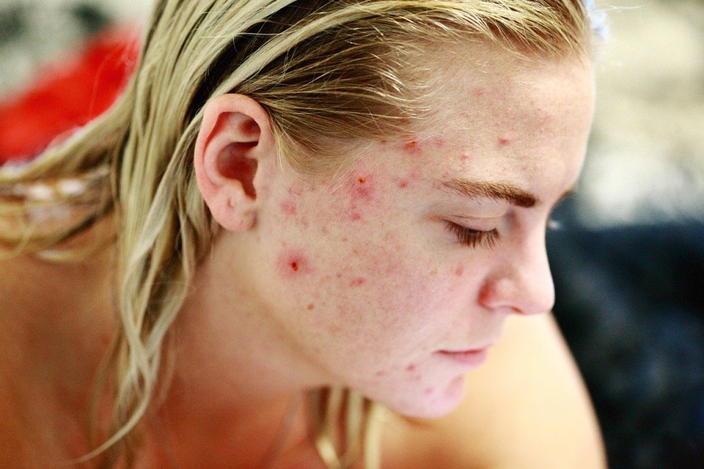 7 Unexpected Acne Breakout Triggers (Sleep Plays A Crucial&nbsp;Role)